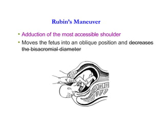 Rubin’s Maneuver
• Adduction of the most accessible shoulder
• Moves the fetus into an oblique position and decreases
the bisacromial diameter
 