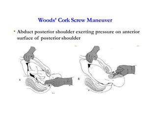 Woods’ Cork Screw Maneuver
• Abduct posterior shoulder exerting pressure on anterior
surface of posterior shoulder
 