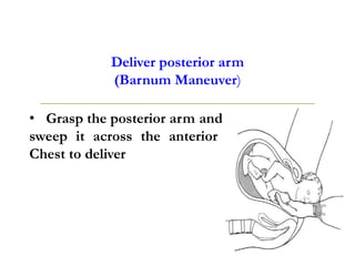 Deliver posterior arm
(Barnum Maneuver)
• Grasp the posterior arm and
sweep it across the anterior
Chest to deliver
 