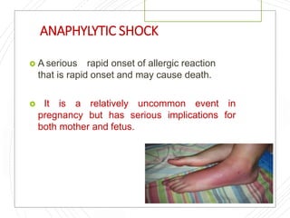 ANAPHYLYTIC SHOCK
 A serious rapid onset of allergic reaction
that is rapid onset and may cause death.
 It is a relatively uncommon event in
pregnancy but has serious implications for
both mother and fetus.
 