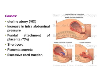 Causes:
• uterine atony (40%)
• Increase in intra abdominal
pressure
• Fundal attachment of
placenta (75%)
• Short cord
• Placenta accreta
• Excessive cord traction
 