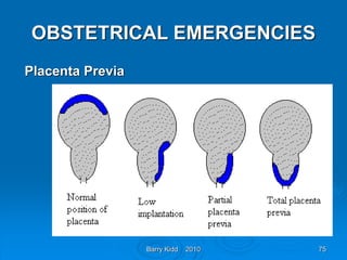 Barry Kidd 2010 75
OBSTETRICAL EMERGENCIES
Placenta Previa
 