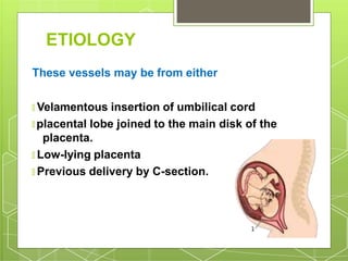ETIOLOGY
These vessels may be from either
🞇 Velamentous insertion of umbilical cord
🞇 placental lobe joined to the main disk of the
placenta.
🞇 Low-lying placenta
🞇 Previous delivery by C-section.
 