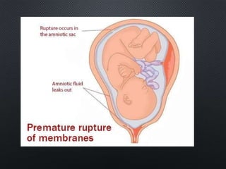 •PPH
Severe bleeding or uterine infection
occurring after delivery is a serious,
potentially fatal situation.
 