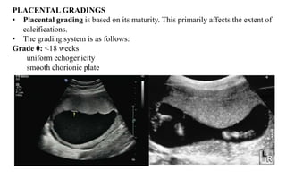 PLACENTAL GRADINGS
• Placental grading is based on its maturity. This primarily affects the extent of
calcifications.
• The grading system is as follows:
Grade 0: <18 weeks
uniform echogenicity
smooth chorionic plate
 