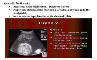 Grade II: ​30-38 weeks
• Occasional basal calcification/ hyperechoic areas
• Deeper indentations of the chorionic plate (does not reach up to the
basal plate).
• Seen as comma type densities at the chorionic plate
 