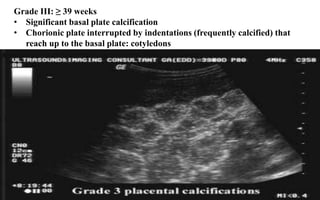 Grade III: ​​≥ 39 weeks
• Significant basal plate calcification
• Chorionic plate interrupted by indentations (frequently calcified) that
reach up to the basal plate: cotyledons
 