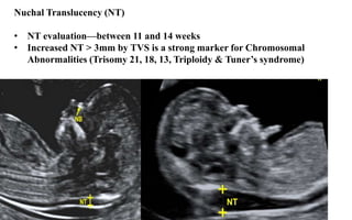 Nuchal Translucency (NT)
• NT evaluation—between 11 and 14 weeks
• Increased NT > 3mm by TVS is a strong marker for Chromosomal
Abnormalities (Trisomy 21, 18, 13, Triploidy & Tuner’s syndrome)
 