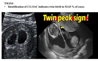TWINS
• Identification of 2 G-SAC indicates twin birth in 52-63 % of cases.
 