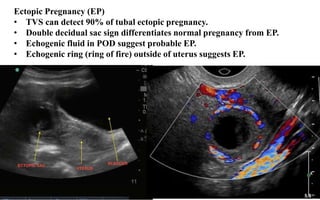 Ectopic Pregnancy (EP)
• TVS can detect 90% of tubal ectopic pregnancy.
• Double decidual sac sign differentiates normal pregnancy from EP.
• Echogenic fluid in POD suggest probable EP.
• Echogenic ring (ring of fire) outside of uterus suggests EP.
 
