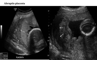 Abruptio placenta
 