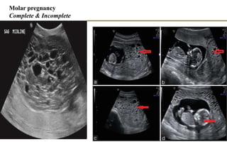 Molar pregnancy
Complete & Incomplete
 