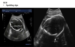 IUD
• Spalding sign
 