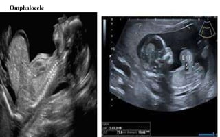 Omphalocele
 