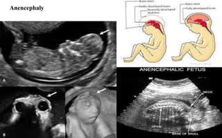 Anencephaly
 