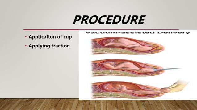 OBSTETRICAL OPERATIONS & PROCEDURES.pptx