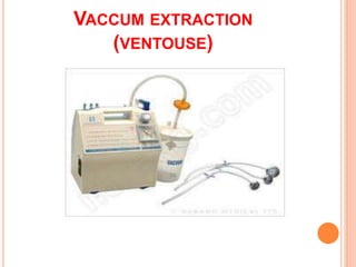 VACCUM EXTRACTION
(VENTOUSE)
 