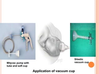 Mityvac pump with
tube and soft cup
Application of vacuum cup
Silastic
vacuum cup
 