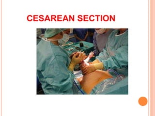 CESAREAN SECTION
 