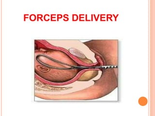 FORCEPS DELIVERY
 