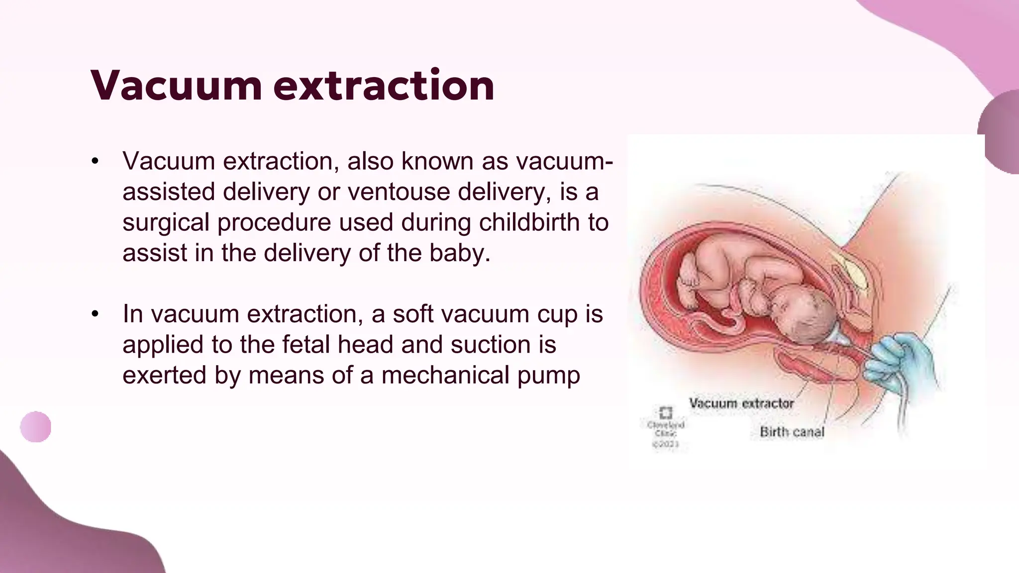 Using Forceps During Delivery Obstetrical Surgeries - Operative vaginal deliveries are accomplished ...