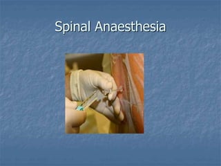 Spinal Anaesthesia
 