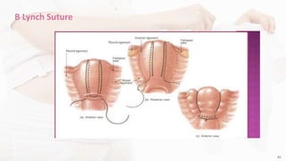 83Copyright © 2014 Well Woman Clinic. All rights reserved. 83
B Lynch Suture
 