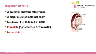 86Copyright © 2014 Well Woman Clinic. All rights reserved.
Rupture Uterus
 A potential obstetric catastrophe
 A major cause of maternal death
 Incidence: 1 in 1148 to 1 in 2250
 Complete (Spontaneous & Traumatic)
 Incomplete
 