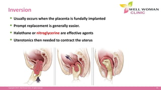95Copyright © 2014 Well Woman Clinic. All rights reserved.
Inversion
 Usually occurs when the placenta is fundally implanted
 Prompt replacement is generally easier.
 Halothane or nitroglycerine are effective agents
 Uterotonics then needed to contract the uterus
 
