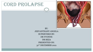 CORD PROLAPSE
BY:
JEEVANTHANY ANGELA
SUPERVISED BY:
DR YVONNE
DR REZA
PRESENTED ON:
31ST
DECEMBER 2021
 