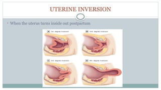 UTERINE INVERSION
• When the uterus turns inside out postpartum
 