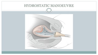 HYDROSTATIC MANOEUVRE
 
