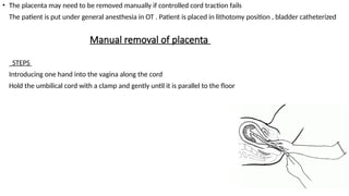 Manual removal of placenta
• The placenta may need to be removed manually if controlled cord traction fails
• The patient is put under general anesthesia in OT . Patient is placed in lithotomy position , bladder catheterized
• STEPS
• Introducing one hand into the vagina along the cord
• Hold the umbilical cord with a clamp and gently until it is parallel to the floor
 