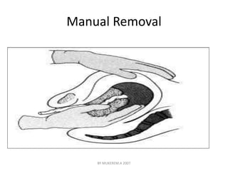 Manual Removal 
BY MUKEREM.A 2007 
 