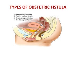 TYPES OF OBSTETRIC FISTULA
 