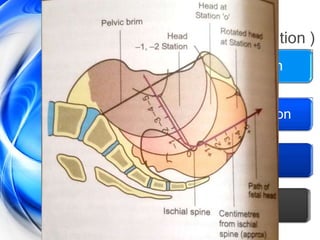 Technique
(of low & outlet forceps application )
Step I-Identification & Application
Step II-Locking of Blades & Fixation
Step III-Traction
Step IV- Removal of Blades
 
