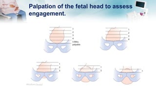 Palpation of the fetal head to assess
engagement.
 