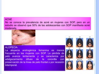 ACNÉ
No se conoce la prevalencia de acné en mujeres con SOP, pero en un
estudio se observó que 50% de las adolescentes con SOP manifiesta acné
moderada.
ALOPECIA
La alopecia androgénica femenina es menos
frecuente en las mujeres con SOP. La pérdida de
pelo avanza lentamente y se caracteriza por
adelgazamiento difuso de la coronilla con
preservación de la línea de pelo frontal o por recesión
bitemporal.
 