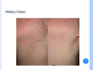 HIRSUTISMO
 