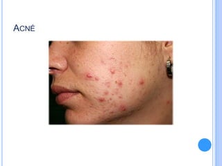 ACNÉ
 
