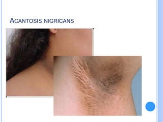 ACANTOSIS NIGRICANS
 