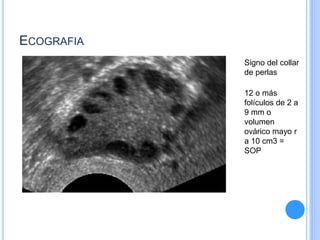 ECOGRAFIA
Signo del collar
de perlas
12 o más
folículos de 2 a
9 mm o
volumen
ovárico mayo r
a 10 cm3 =
SOP
 
