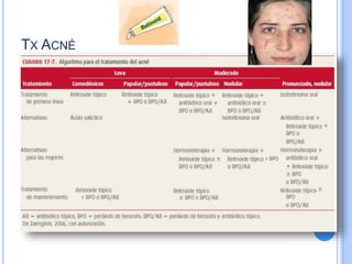 TX ACNÉ
 Reducción de la concentración de andrógenos.
 Anticonceptivos Orales Combinados
 Antiandrógenos como Espironolactona o
Flutamida
 Inhibidores de la 5 reductasa (Finasterida)
 