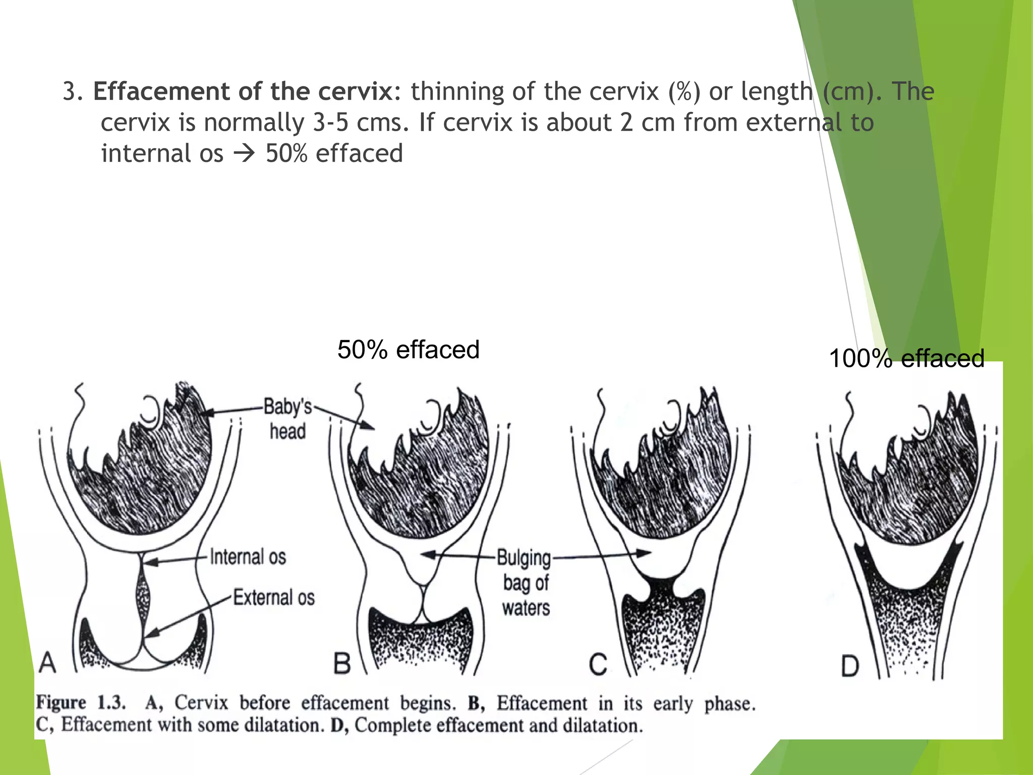 3. Effacement of the cervix: thinning of the cervix (%) or length (cm). The 
cervix is normally 3-5 cms. If cervix is about 2 cm from external to 
internal os  50% effaced 
50% effaced 100% effaced 
 