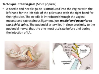 Technique: Transvaginal (More popular)
• A needle and needle guide is introduced into the vagina with the
left hand for the left side of the pelvis and with the right hand for
the right side. The needle is introduced through the vaginal
mucosa and sacrospinous ligament, just medial and posterior to
the ischial spine. The pudendal artery lies in close proximity to the
pudendal nerve; thus the one must aspirate before and during
the injection of LA.
 