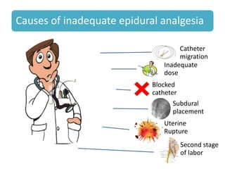 Causes of inadequate epidural analgesia
Catheter
migration
Inadequate
dose
Blocked
catheter
Subdural
placement
Uterine
Rupture
Second stage
of labor
 