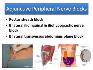 Adjunctive Peripheral Nerve Blocks
• Rectus sheath block
• Bilateral ilioinguinal & iliohypograstic nerve
block
• Bilateral transversus abdominis plane block
 