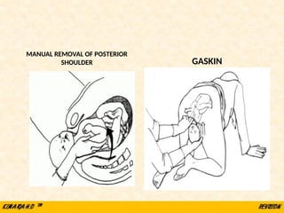 MANUAL REMOVAL OF POSTERIOR
SHOULDER GASKIN
 