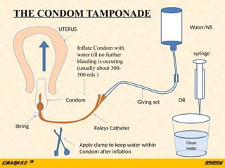 Inflate Condom with
water till no further
bleeding is occuring
(usually about 300-
500 mls )
UTERUS
Foleys Catheter
Condom
String
Apply clamp to keep water within
Condom after inflation
Giving set
Water/NS
OR
syringe
THE CONDOM TAMPONADE
Clean
water
 