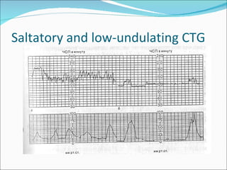 Saltatory and low-undulating CTG 